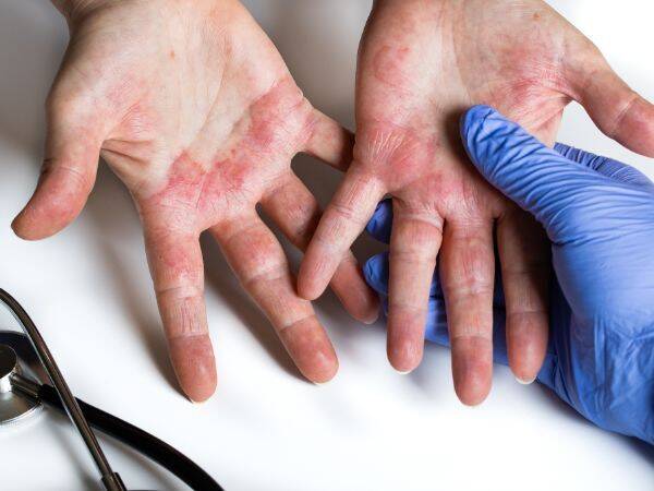 Leczenie AZS - jak leczyć atopowe zapalenie skóry?